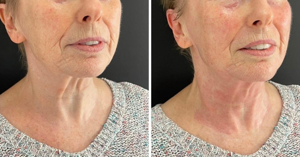 Before and after photos showing the effect of HIFU treatment on a client's neck following treatment at HIFU Clinics UK.