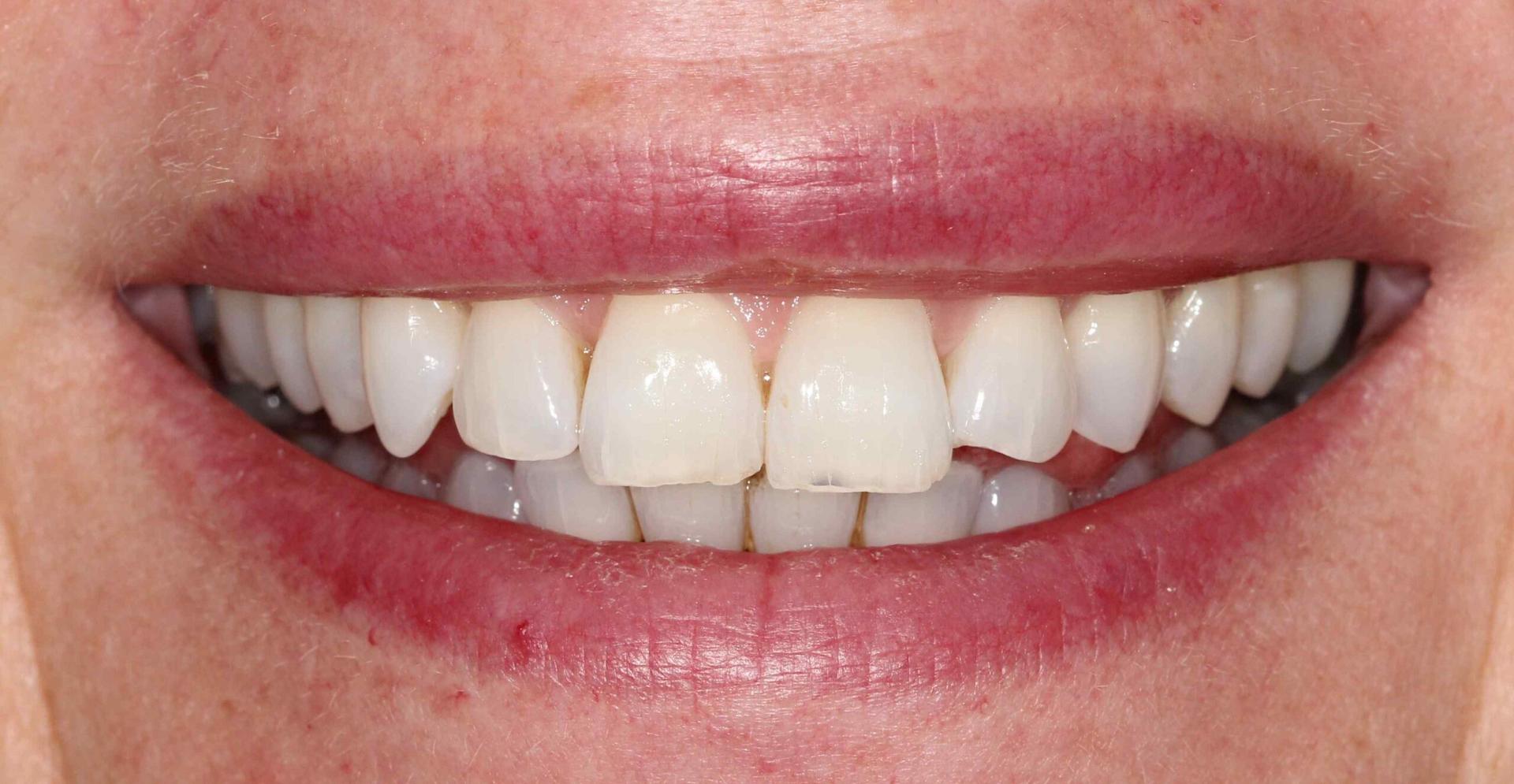 after-ortho-whitening-1